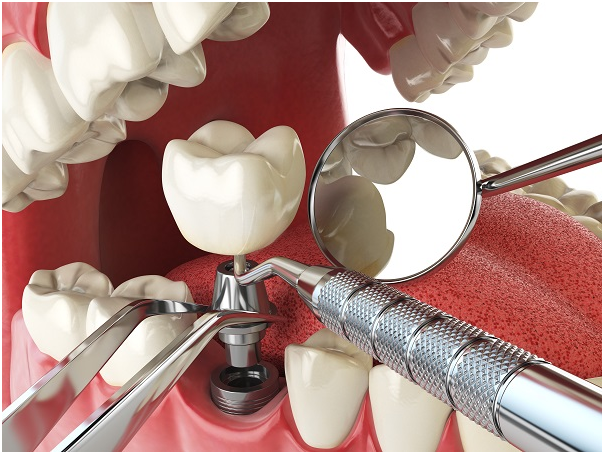 Alternative Options to a Dental Implant