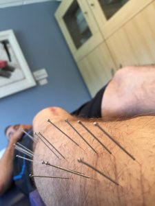 Benefits of Dry Needling in Relieving Body Pain and Soreness