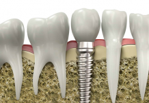All Interesting Facts about Implanted Teeth