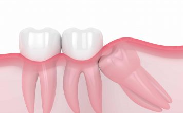 Important Considerations about Wisdom Tooth Extraction